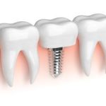 Reasons to Replace Missing Teeth Kennesaw, GA