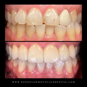 Before and after treatment: Image 2